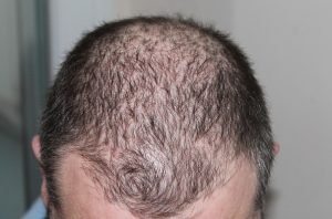 Image_SBWeb_May 14_Hair Loss